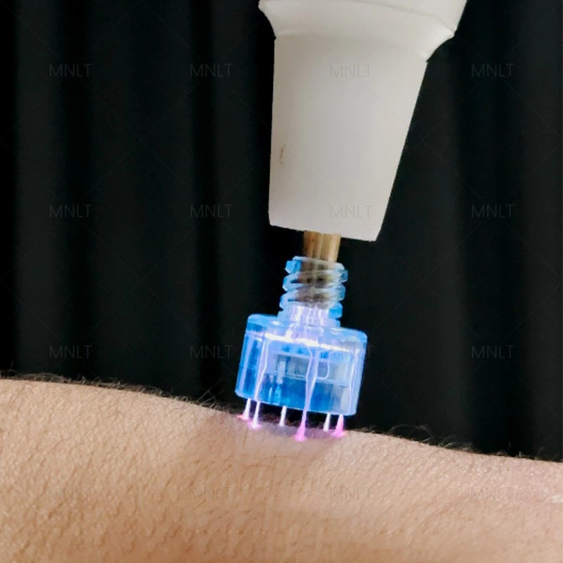 Newest Fractional Cold Plasma high quality